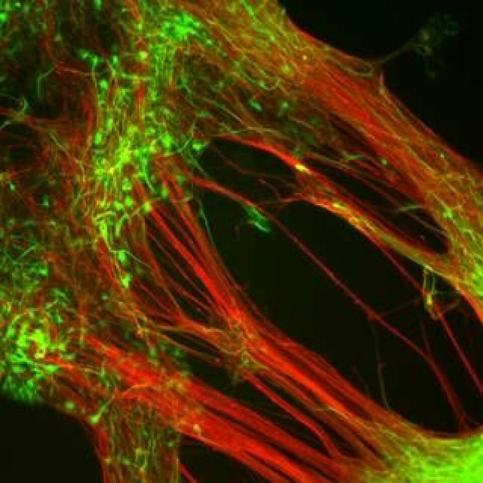 Stamcellerna som har utvecklats till nervceller (röda) samt dopaminceller (gröna). Foto: Kennet Rouna