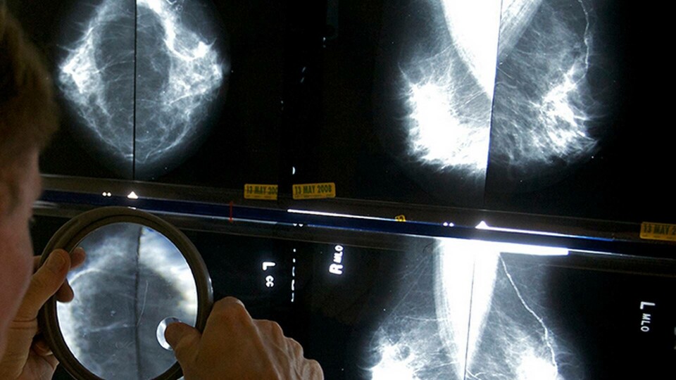 Dödligheten i cancer fortsätter att minska. Detta trots att antalet svenskar som drabbas av elakartade tumörer ökar. Foto: TT Dödligheten i cancer fortsätter att minska. Detta trots att antalet svenskar som drabbas av elakartade tumörer ökar. Foto: TT