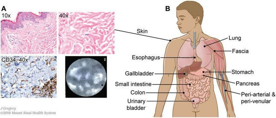 En illustration i Scientific Reports som visar var forskare har upptäckt 'interstitium', kanske ett nytt mänskligt organ. Foto: Jill Gregory/Mount Sinai Health Systems, via CC En illustration i Scientific Reports som visar var forskare har upptäckt 'interstitium', kanske ett nytt mänskligt organ. Foto: Jill Gregory/Mount Sinai Health Systems, via CC