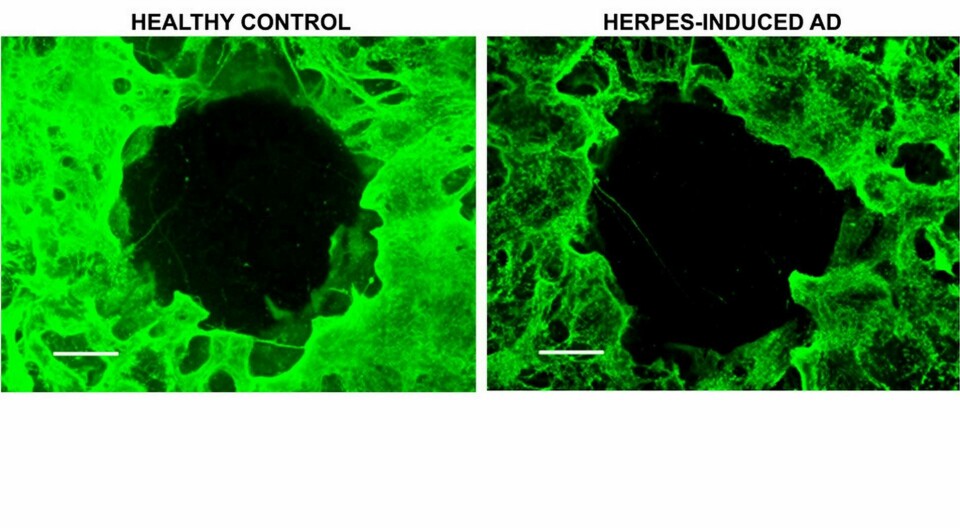 Forskarna har bland annat sett hur den odlade minihjärnan förlorar nervceller när den infekteras av munsårsvirus. Den vänstra bilden visar frisk hjärnvävnad, den högra infekterad. Foto: Dana M. Cairns/TT