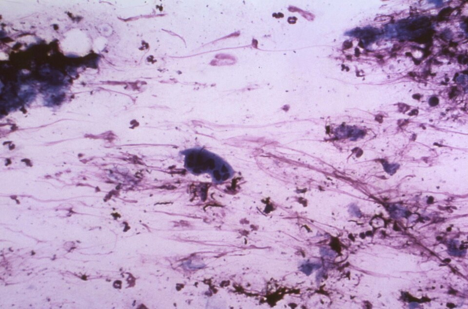Herpesvirus, som har förändrats har visat sig effektivt kunna angripa cancerceller. Arkivbild. Foto: K.L. Herrmann/CDC/TT Herpesvirus, som har förändrats har visat sig effektivt kunna angripa cancerceller. Arkivbild. Foto: K.L. Herrmann/CDC/TT