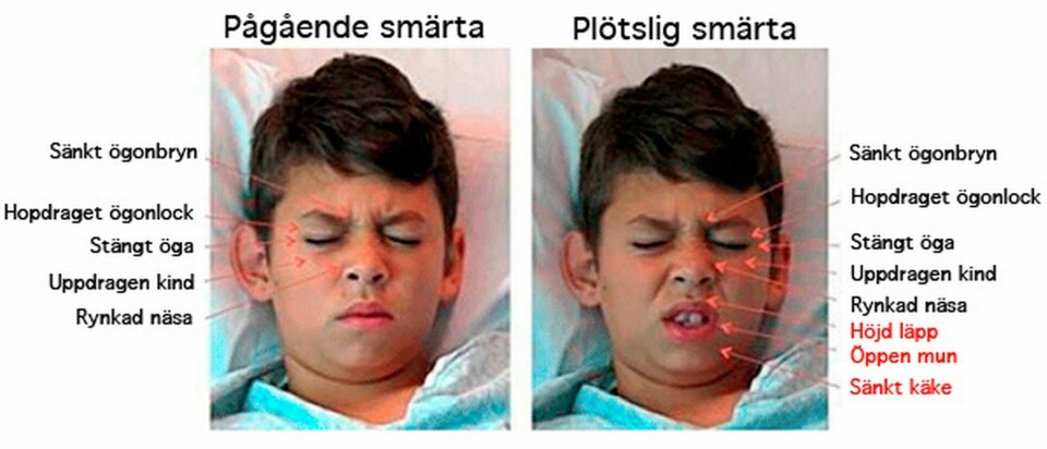 Ett sjukt barn med öppen mun och höjd överläpp kan visa att smärtan är plötslig. Foto: US San Diego