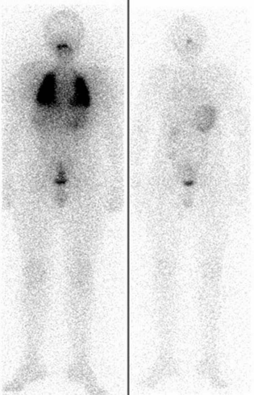 13 årig pojke med sköldkörtelcancer och metastaser i lungorna. Bild till vänster före terapin. Efter fyra radiojodbehandlingar var metastaserna borta. Foto: Universitetskliniken i Würzburg