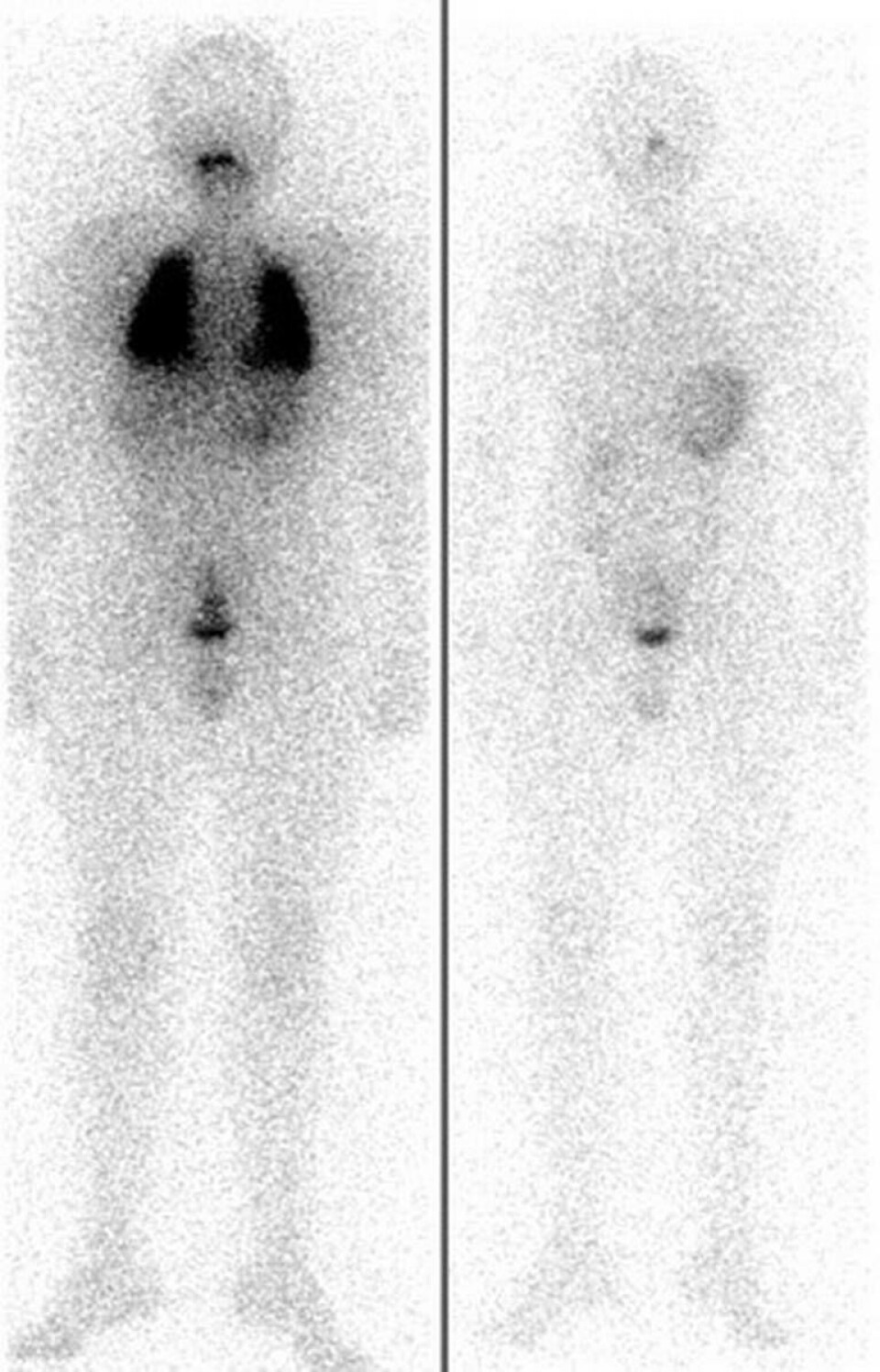 13 årig pojke med sköldkörtelcancer och metastaser i lungorna. Bild till vänster före terapin. Efter fyra radiojodbehandlingar var metastaserna borta. Foto: Universitetskliniken i Würzburg 13 årig pojke med sköldkörtelcancer och metastaser i lungorna. Bild till vänster före terapin. Efter fyra radiojodbehandlingar var metastaserna borta. Foto: Universitetskliniken i Würzburg