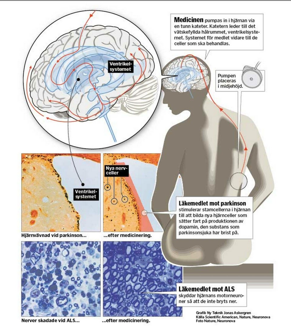 Svenskar testar ny metod bota parkinson