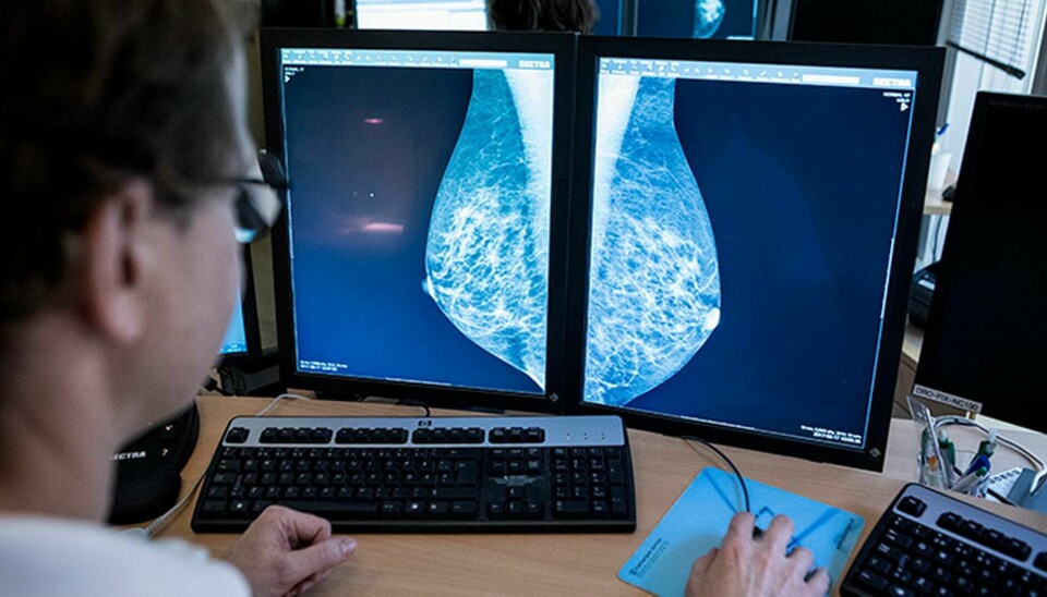 En läkare tittar på bröströntgenbilder, mammografibilder. Foto: Christine Olsson / TT