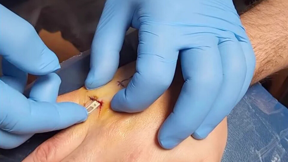 Vivokey Apex-chipet på väg in i Brandon Dalalys arm. Foto: Brandon Dalaly/Youtube Vivokey Apex-chipet på väg in i Brandon Dalalys arm. Foto: Brandon Dalaly/Youtube