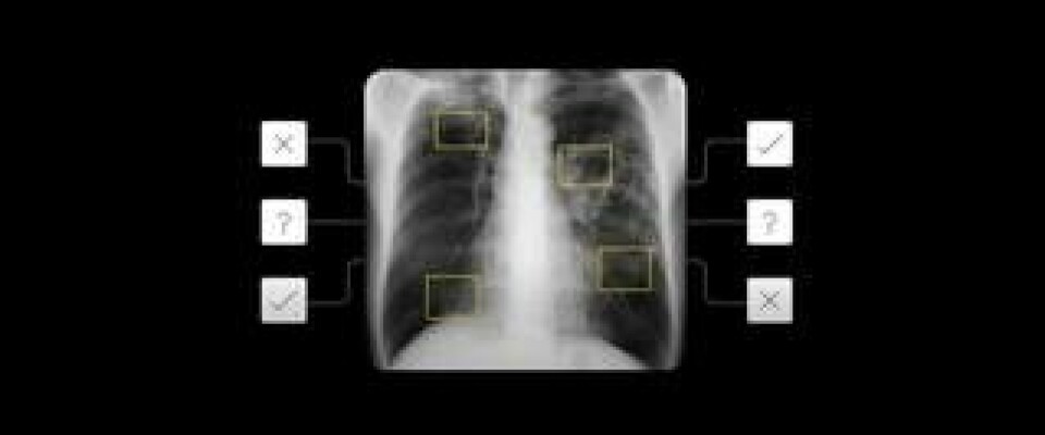 Utifrån röntgenbilder ska Googles nya ai kunna identifiera tuberkulos. Foto: Google