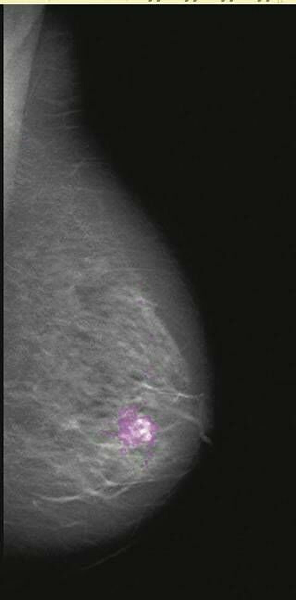Här syns det första fallet av bröstcancer som avslöjades med den nya tekniken.