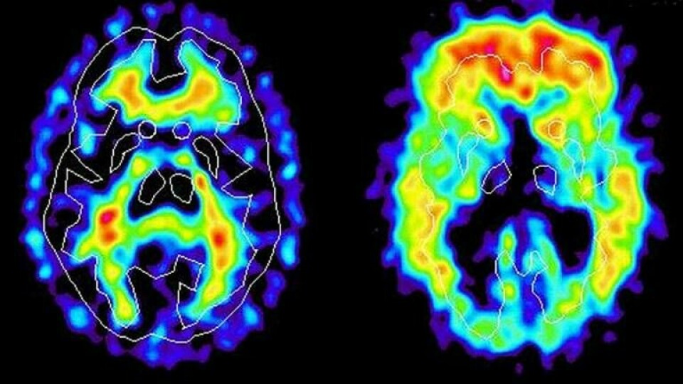 Arkivbild från 2002 från när svenska forskare tagit unika bilder av de proteinklumpar som bildas i hjärnan vid alzheimers sjukdom. Foto: UPPSALA UNIVERSITET/SCANPIX/TT