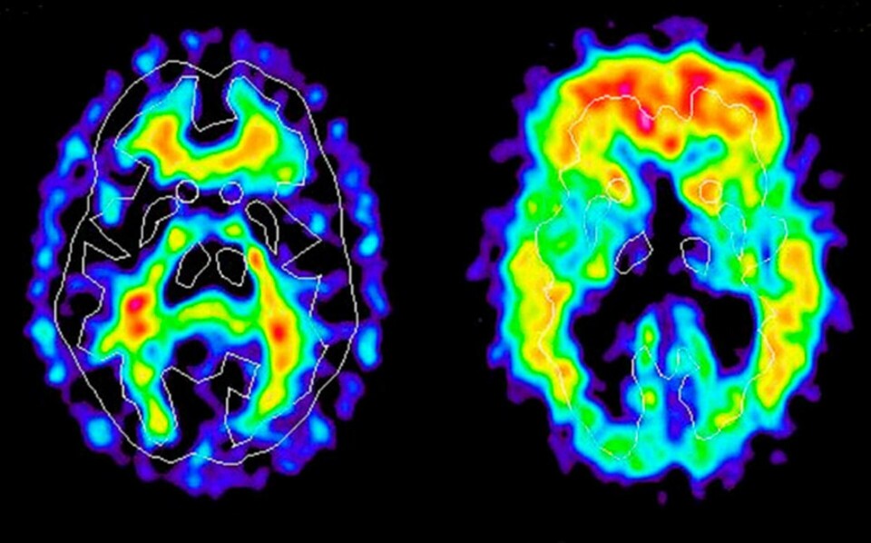 2002 tog svenska forskare då unika bilder med PET-kamera av de proteinklumpar som bildas i hjärnan vid alzheimers sjukdom. Bilden till höger visar anhopningar av knölar – amyloida plack - i pannloben och i tinningloberna. Bilden till vänster föreställer hjärnan hos en frisk person. Foto: Uppsala Universitet 2002 tog svenska forskare då unika bilder med PET-kamera av de proteinklumpar som bildas i hjärnan vid alzheimers sjukdom. Bilden till höger visar anhopningar av knölar – amyloida plack - i pannloben och i tinningloberna. Bilden till vänster föreställer hjärnan hos en frisk person. Foto: Uppsala Universitet