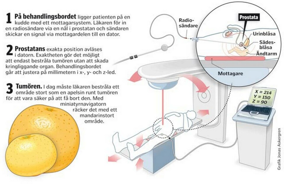 Så går strålbehandlingen till. Grafik: Jonas Askergren Så går strålbehandlingen till. Grafik: Jonas Askergren