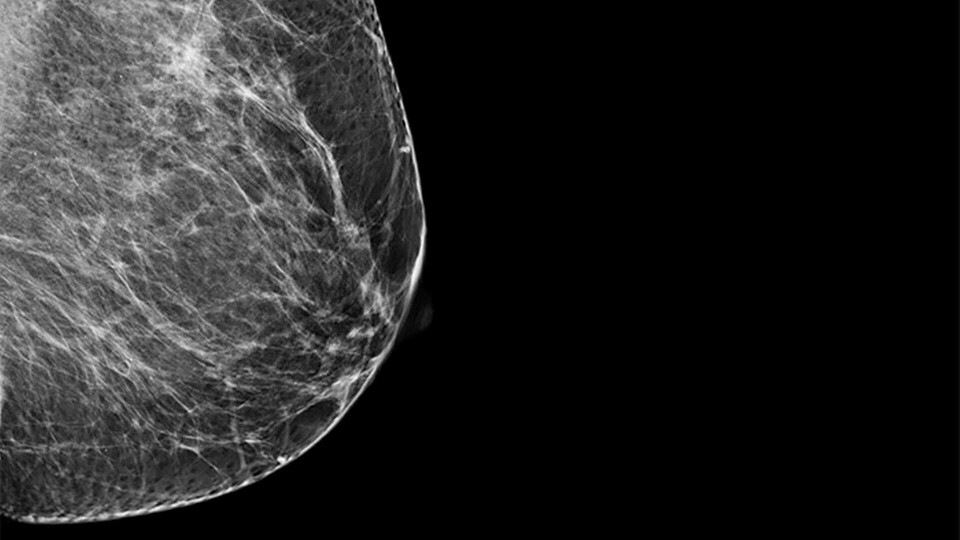 Röntgenbild på ett bröst under mammografi-undersökning. Foto: Alamy