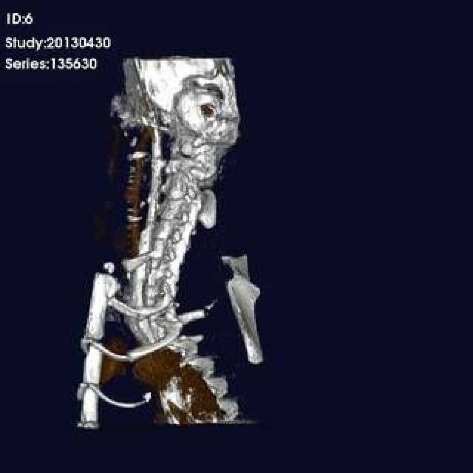 Datortomografi visar att matstrupsdelen integrerats i mottagarens kropp. Den varken läcker eller har töjts ut. Foto: Karolinska institutet